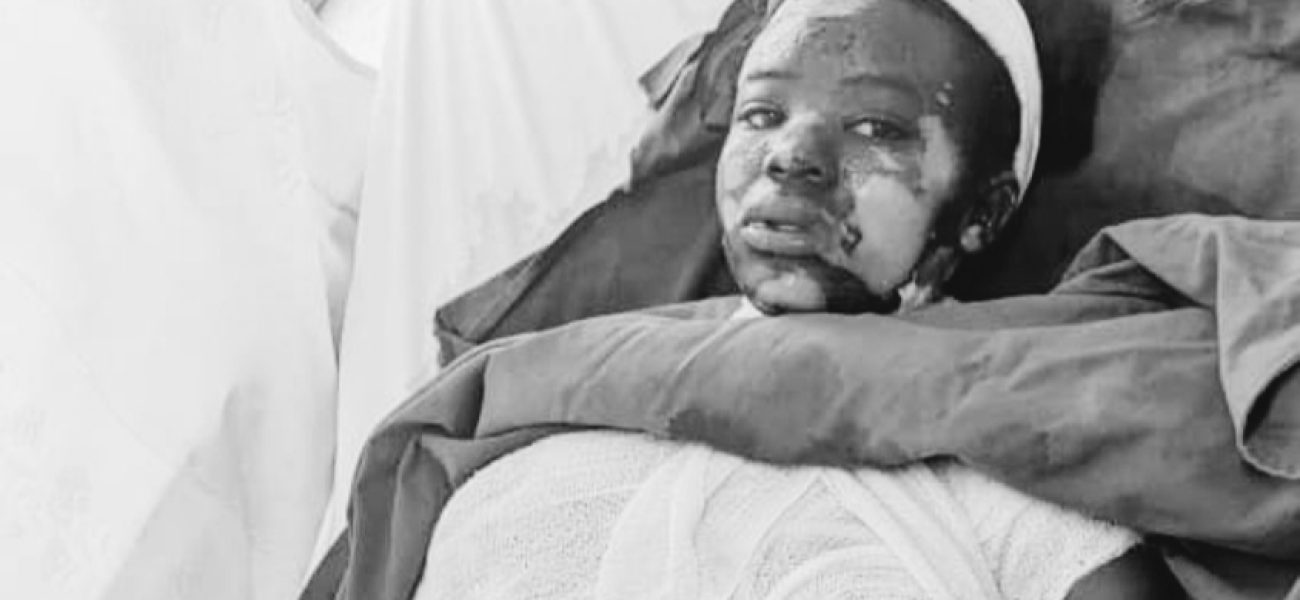 Ngororero: Umuganga yatwikishije amazi ashyushye umukozi we wo mu rugo