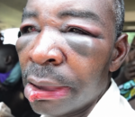 Bugesera: Umugabo yarumye umunwa w’umunyerondo arawumira